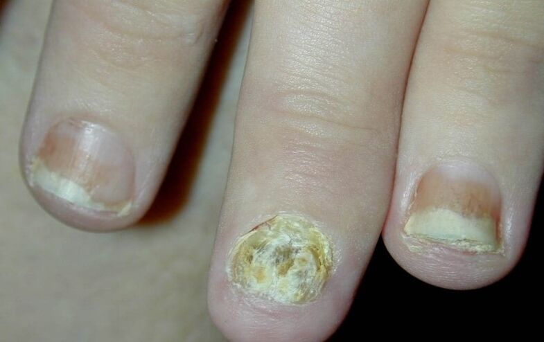 hand nagel psoriasis