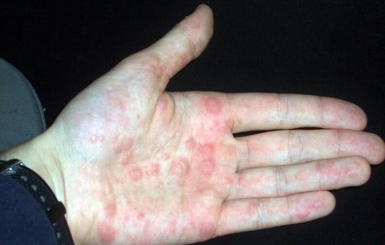 plaque psoriasis op de handen
