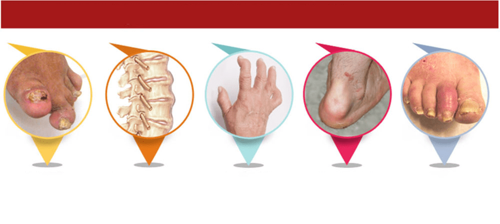 soorten artritis psoriatica