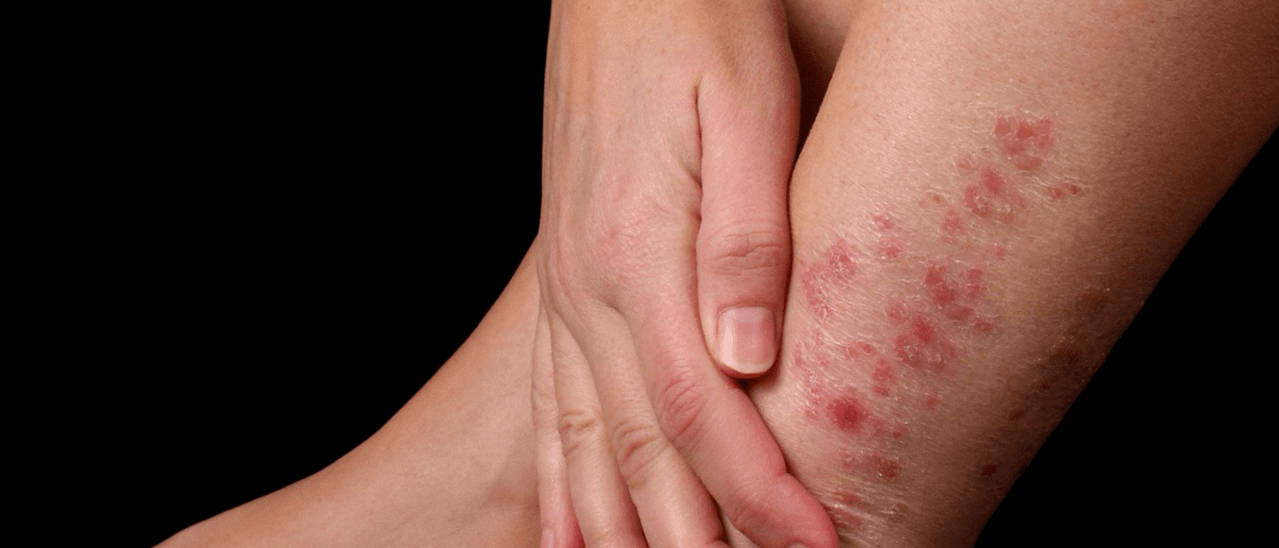 Psoriasisplaques op de huid van het been
