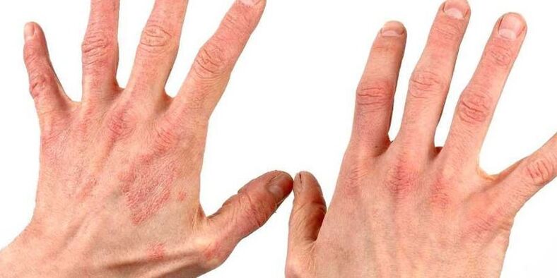 psoriasis op de handen hoe folkremedies te behandelen
