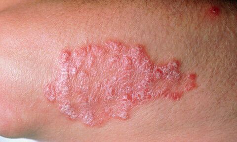 psoriasis op de huid foto 2