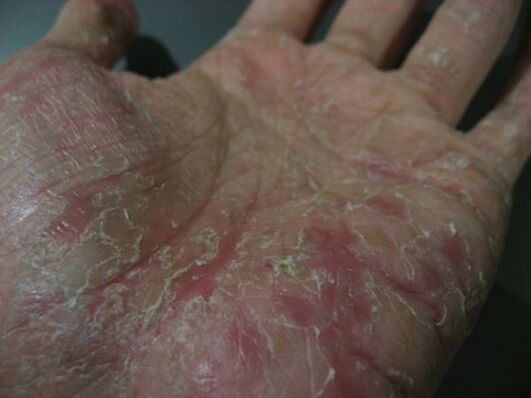 psoriasis in de palm van je hand