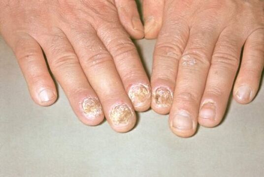 psoriasis nagel foto 1
