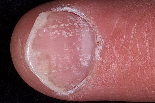 psoriasis nagel foto 2