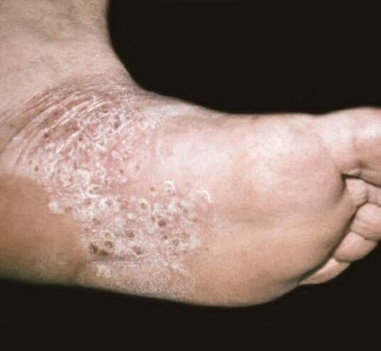 psoriasis op de voet