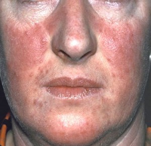 hoe de behandeling van psoriasis op het gezicht