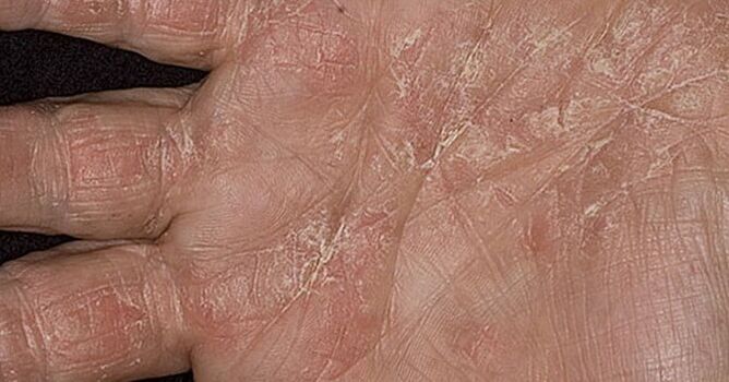 psoriasis op de handpalmen