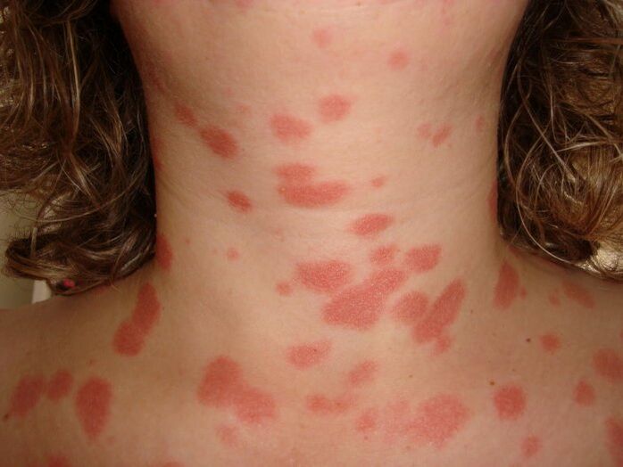 Psoriatische plaques op de huid