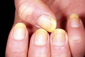 psoriasis van nagels