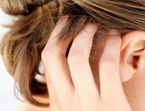 tekenen en symptomen van psoriasis op de hoofdhuid