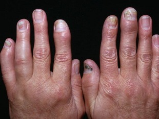 psoriasis artritis