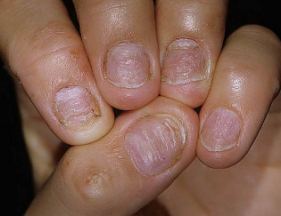 psoriasis van de nagels